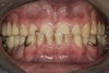 Figure 1  Intraoral anterior view of the patient presenting a severely worn maxillary dentition and loss of OVD.