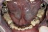Figure 3  Intraoral occlusal view of mandibular dentition with the existing removable prosthesis presenting excessive signs of wear.