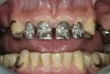 Figure 13  Maxillary prosthesis framework try-in. Anterior view.