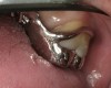 Figure 15  Maxillary prosthesis framework try-in. Metal occlusal surfaces on the left molar.