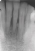 Figure 2  The preoperative radiograph shows healthy cuspids and advanced periodontal disease on the four mandibular incisors.
