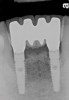 Figure 12  The 4-year postoperative radiograph.